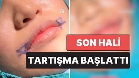 Barbie Gülüş Estetiği Yaptıran Kadın, Son Haliyle Joker'e Benzetildi