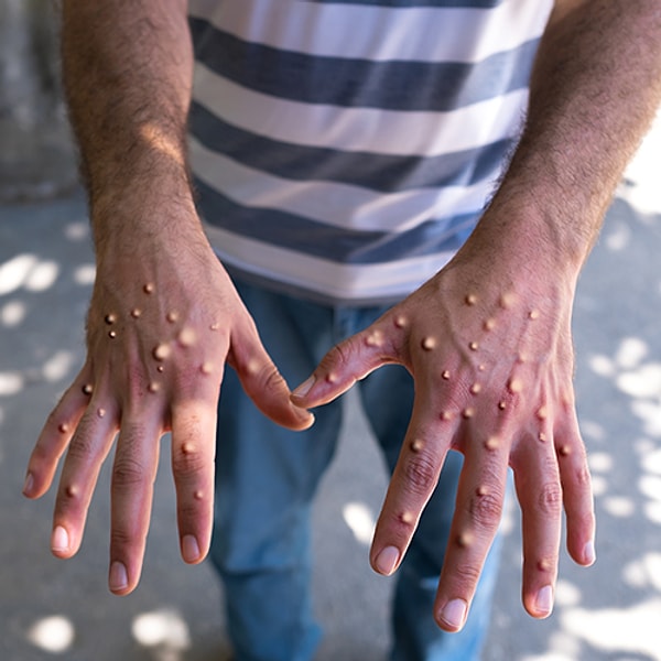 Bildiğiniz gibi Dünya Sağlık Örgütü geçtiğimiz gün Afrika'da maymun çiçeği (monkey pox) hastalığının artması sebebiyle acil durum ilan etti