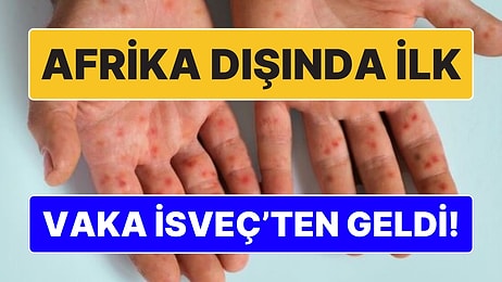 Afrika Dışında İlk Vaka: İsveçli Yetkililer Maymun Çiçeği Varyantı Vakasını Açıkladı!