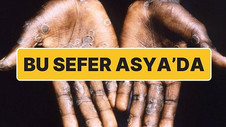 Bu Sefer Asya’da: Pakistan'da Maymun Çiçeği (Mpox) Tespit Edildi