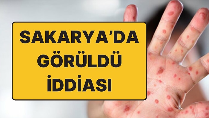 Sakarya’da Maymun Çiçeği Vakası Görüldü İddiası: Sağlık Müdürlüğünden Yalanlama