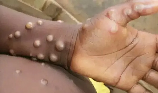 Maymun Çiçeği (Mpox) virüsünün Afrika’daki yayılım hızındaki artış sebebiyle Dünya Sağlık Örgütü küresel çapta uyarı yayınlanmıştı.