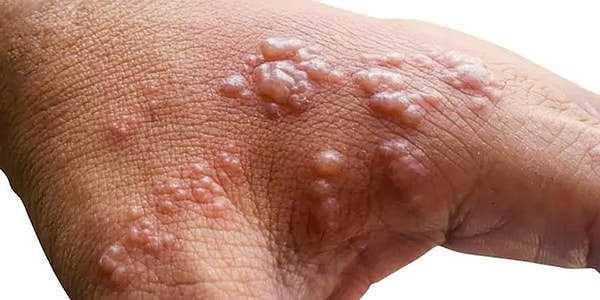 What Are the Symptoms of Monkeypox Virus?