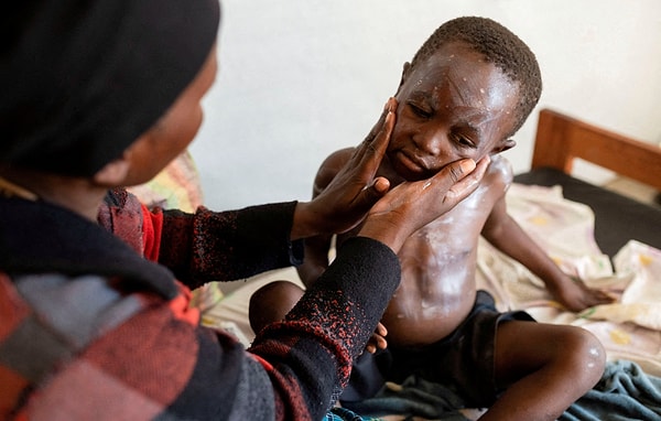 Bağışıklık sistemlerinin daha az gelişmiş olması nedeniyle çocukların mpox salgınından daha fazla etkilendiği görülüyor. Çiçek hastalığının yayılmasında yakın temasın önemli bir rol oynadığını vurgulayan Dr. Ngadjole, "Çocuklar her zaman birlikte oynuyorlar ve sosyal mesafeye pek önem vermiyorlar" diyor.