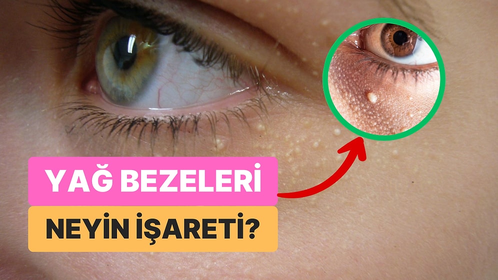 Göz Çevresindeki Beyaz Noktalar-Yağ Bezeleri Sağlığımızla İlgili Neye İşaret Ediyor?