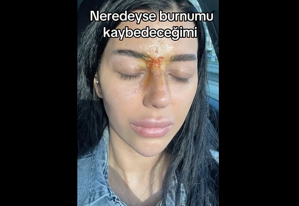 Geçici görme kaybı yaşayan kadın burnunu kaybetme noktasına geldi.