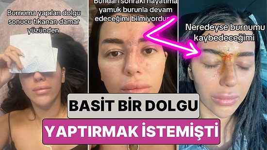 Bir Kadın Basit Bir Dolgu Yaptırmak İsterken Geçici Görme Kaybı Yaşayıp Burnunu Kaybetme Noktasına Geldi