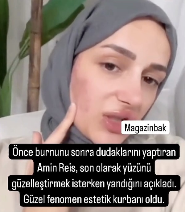 Geçtiğimiz saatlerde ise, bomba bir estetik meselesiyle daha gündeme oturdu. Estetiğe doymayan Amin Reis'in yüzü yanlış işlem dolayısıyla yandı.