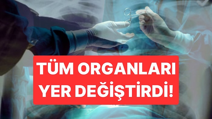 Tüm Organları Yer Değiştirdi! Dünyada İlk Kez Türkiye'de Görülen Hastalığa Giresun Sendromu Adını Verdiler