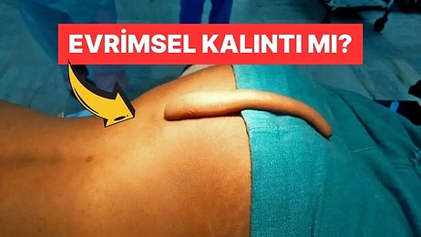 Bazı İnsanların Tıpkı Hayvanlar Gibi Kuyrukla Doğmasının Sebebi Nedir?