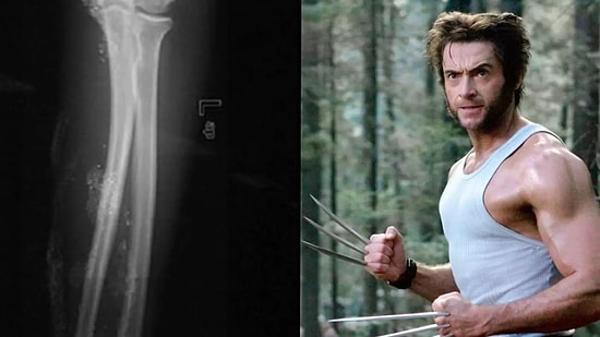 Teen Injects Mercury Into His Arm to Become Wolverine