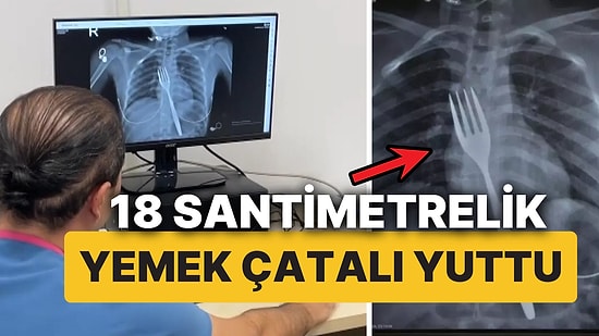 Genç Kadının Yuttuğu 18 Santimetrelik Yemek Çatalı Bilimsel Makaleye Konu Olacak!