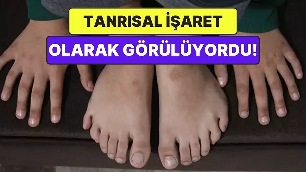 Bazı İnsanlar Ebeveyni 5 Parmaklı Olmasına Rağmen Neden 6 Parmakla Doğar?