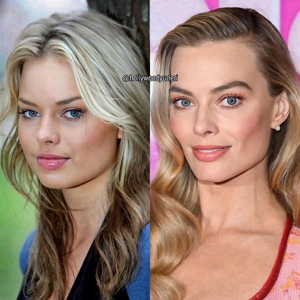 Elmacık kemiklerinin altındaki yağ dokusu alınan Margot Robbie'nin böylece daha keskin hatlara kavuşması sağlanmış.