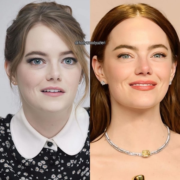 Göz kapağı alınan Emma Stone'un üç kere burnundan ameliyat geçirdiği, yıllar boyunca yüzünün farklı bölgelerine botoks uygulandığı ve dudak dolgusu sayesinde daha kalın dudaklara kavuştuğu açıkça gözlemlenen değişimlerden.