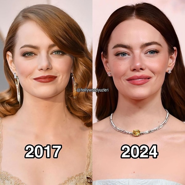 @hollywoodyuzleri adlı hesabın sahibi Berk Yılmaz'ın estetik incelemesine göre, Emma Stone burnundan birkaç kez operasyon geçirmiş!