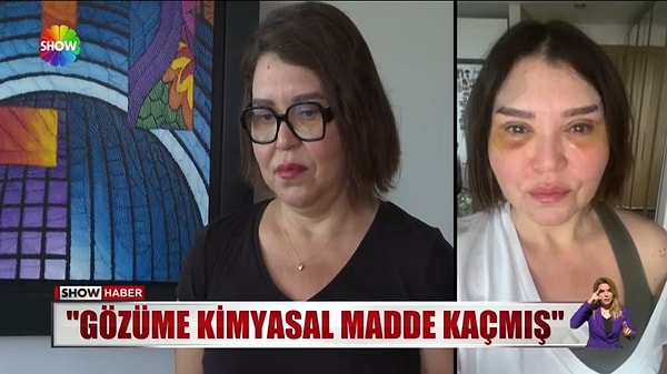 Övet yaşanan olay sonrasında sağ gözünde kısmi, sol gözünde ise tamamen görme kaybı yaşadığını belirtmişti.