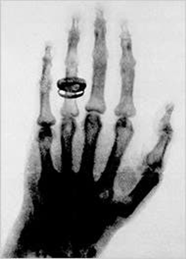 10. 1986: İlk X-Ray