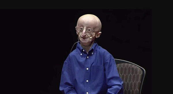 4. Progeria halk arasında "Yaşlı Çocuk Hastalığı" veya "Hızlanmış Yaşlanma Sendromu" olarak bilinir ve çocukları etkileyen son derece nadir bir genetik hastalıktır.