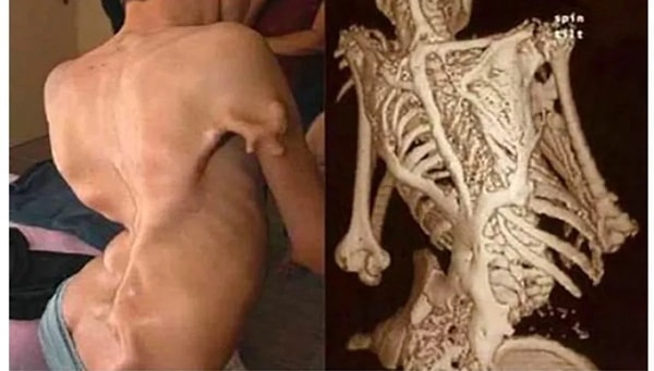 9. F.O.P. Hastalığı (tam adıyla Fibrodysplasia Ossificans Progressiva), son derece nadir ve korkutucu bir genetik bozukluktur.