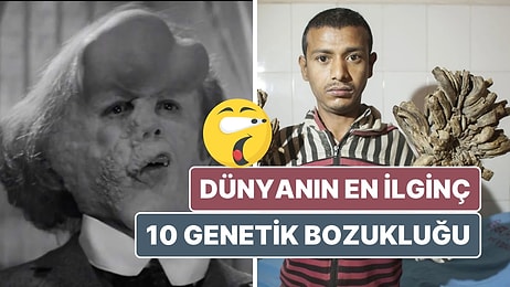 Vampir Hastalığı'ndan Fil Adam Sendromu'na: Dünyanın En İlginç 10 Genetik Bozukluğu