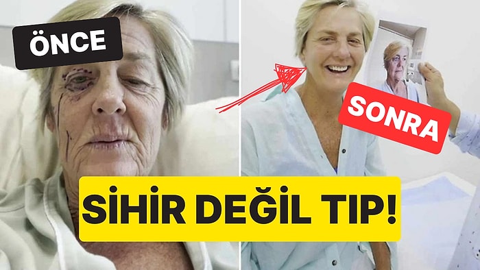 Yüz Gerdirme Ameliyatıyla 30 Yaş Gençleşen Kadının Son Hali Görenleri Dumur Etti