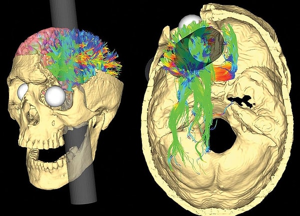 Phineas Gage, fiziksel olarak iyileşti ancak kazadan sonra tamamen farklı bir insana dönüştü. Gage’i tanıyanlar, onun eskiden nazik ve sorumluluk sahibi bir insan olduğunu söylerken, kazadan sonra öfke nöbetleri geçiren, küfür eden ve agresif bir karaktere sahip olduğunu belirtiyorlardı.