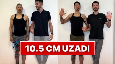 Sancılı Boy Uzatma Ameliyatının Ardından 10.5 cm Uzayan Adamın Değişimi