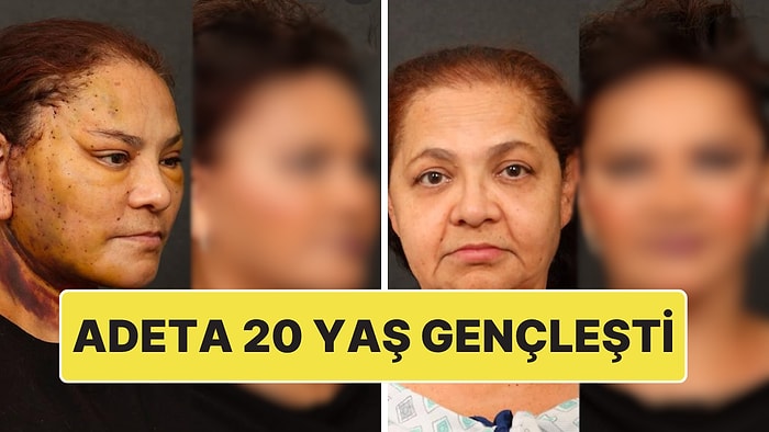 Yüz ve Boyun Gerdirme ile 20 Yaş Gençleşen Kadın Önceki ve Sonraki Haliyle Şaşırttı