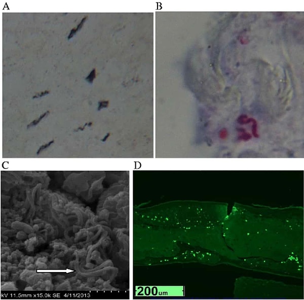 1. Morgellons Hastalığı: Gerçek Bir Tıbbi Durum mu, Yoksa Toplu Bir Sanrı mı?