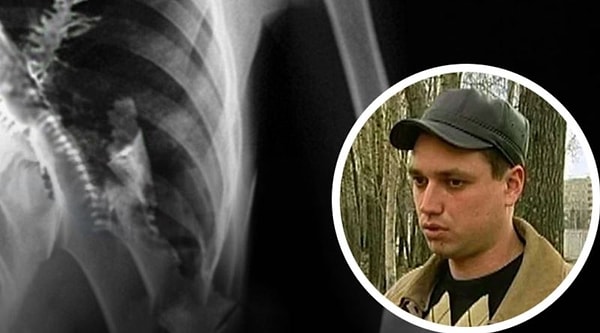 Artyom Sidorkin, haftalarca süren göğüs ağrısı ve kanlı öksürük şikayetleri üzerine doktorlara başvurdu. İlk incelemelerde doktorlar Sidorkin’in akciğerinde tümöre benzeyen bir kitle tespit etti.