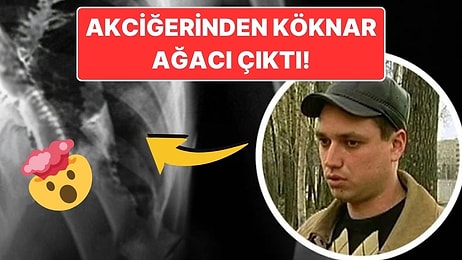 Akciğerinde Köknar Ağacının Büyümesiyle Tıp Dünyasını Şaşkına Çeviren Adam