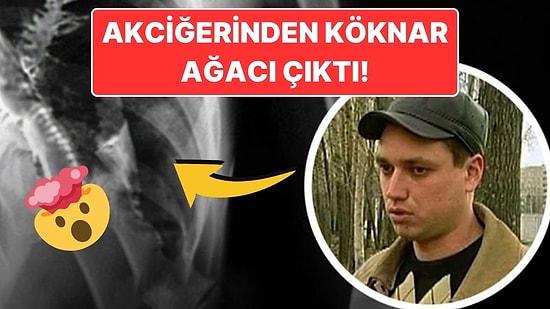 Akciğerinde Köknar Ağacının Büyümesiyle Tıp Dünyasını Şaşkına Çeviren Adam