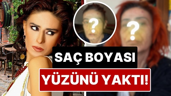 Yüzünün Hali Şoka Soktu: Yıldız Tilbe'nin Suratında Saç Boyası Yüzünden Kimyasal Yanıklar Oluştu!