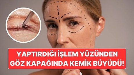 Yaptırdığı Kozmetik İşlem Yüzünden Göz Kapağında Kemik Büyüyen Kadın