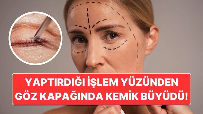 Yaptırdığı Kozmetik İşlem Yüzünden Göz Kapağında Kemik Büyüyen Kadın