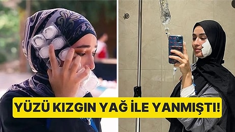 MasterChef'te Kızgın Yağ ile Yüzü Yanan Beyza Yarışma Sonrası Yaşadığı Zorlu Süreci Anlattı!