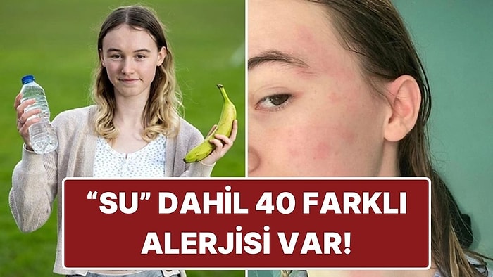 Su Dahil 40 Farklı Şeye Alerjisi Olan Kadın Yaşadığı Zorlukları Anlattı