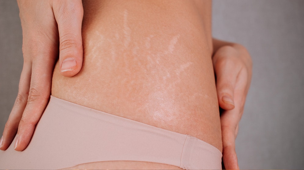 Çatlak Oluşumunu Önlemene Yardımcı Olacak Şey Ne?