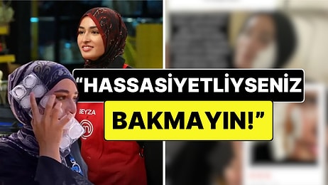 Kızgın Yağ ile Feci Kaza Geçirmişti: MasterChef Beyza Yanan Yüzünün O Halini Net Şekilde Paylaştı!