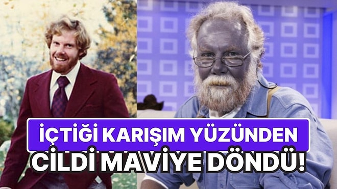 Gerçek Hayatta Şirin Baba: İçtiği Karışım Yüzünden Cildi Maviye Dönüşen Adam