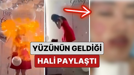 Bir Kadın Doğum Gününde Patlayan Balonlar Yüzünden Yüzünün Geldiği Hali Paylaştı