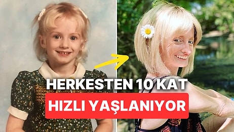 Nadir Görülen Hastalığı Yüzünden Herkesten 10 Kat Daha Hızlı Yaşlanan Kadın