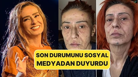 Saç Boyası Yüzünü Yakmıştı: Yıldız Tilbe, Son Durumunu Sosyal Medyadan Duyurdu