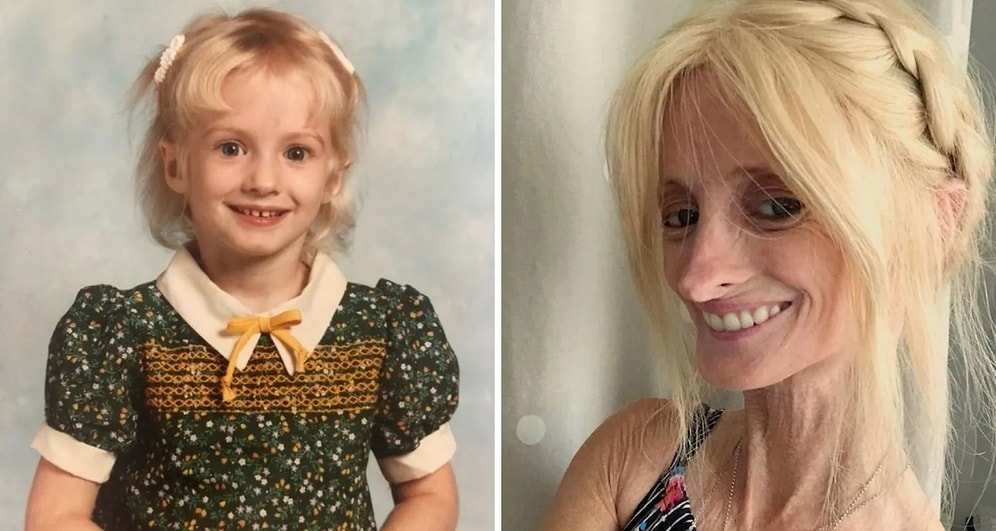 This Woman Is Aging 10 Times Faster Than Anyone Else Due to a Rare Disease