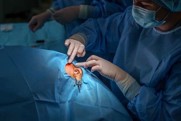 In the next stage, surgeons remove the tooth from the cheek and place it in the eye.