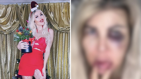 Nazlı Hamarat bu sefer yüreğimizi yakan bir konuyla gündeme geldi. Ünlü fenomen 4 yıllık erkek arkadaşından şiddet gördüğünü açıkladı. Görseli