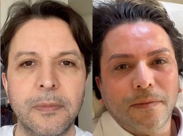 Gündeme sık sık açıklamalarıyla düşen Nihat Doğan son olarak kaşlarına yaptırdığı işlemle magazin manşetlerine yerleşti. Görseli
