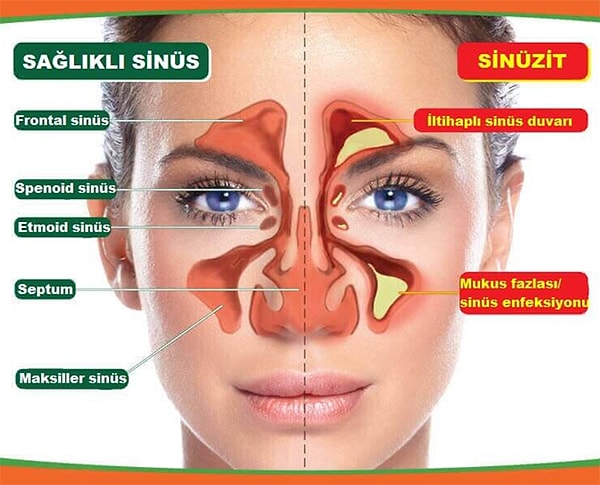 Sinüzit gerçekten de "Allah düşmanımın başına vermesin" dedirtecek cinsten sinir bozucu bir hastalık, çeken bilir. Görseli