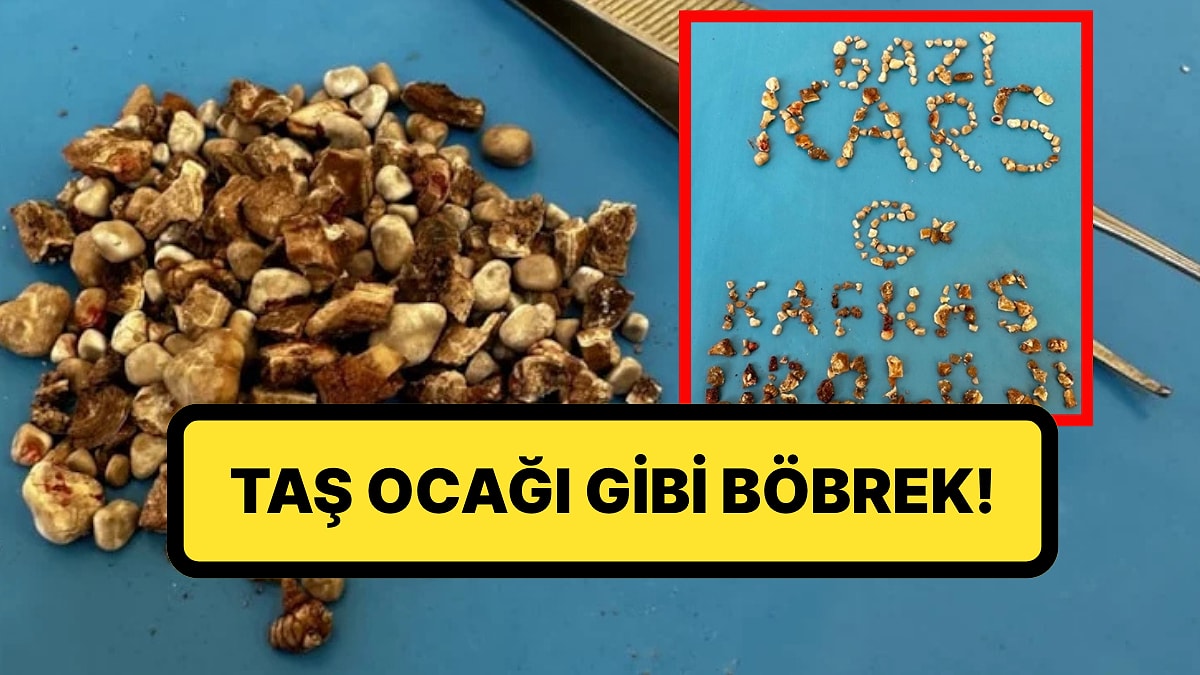 Taş Ocağı Gibi Böbrek: Bir Hastanın İki Böbreğinden 300&apos;ün Üzerinde Taş Çıktı